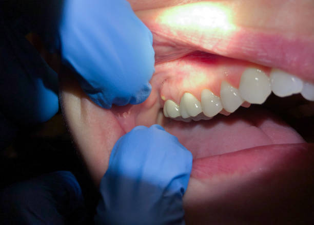 Best Tooth Infection Emergency Dentist  in Webster City, IA